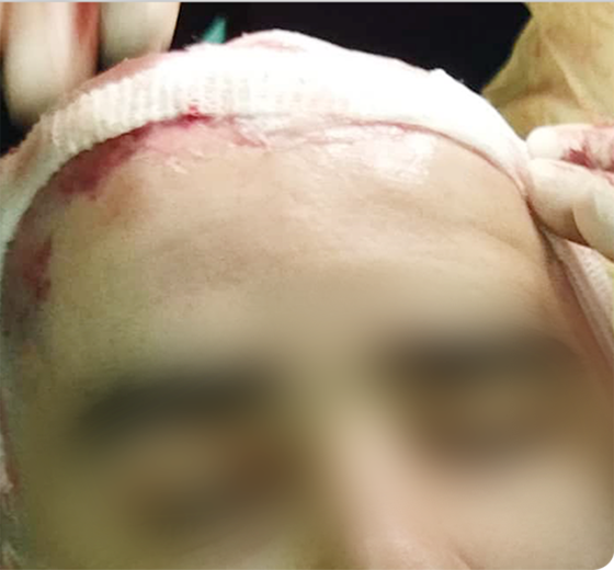 Cranium PEEK implant case 07